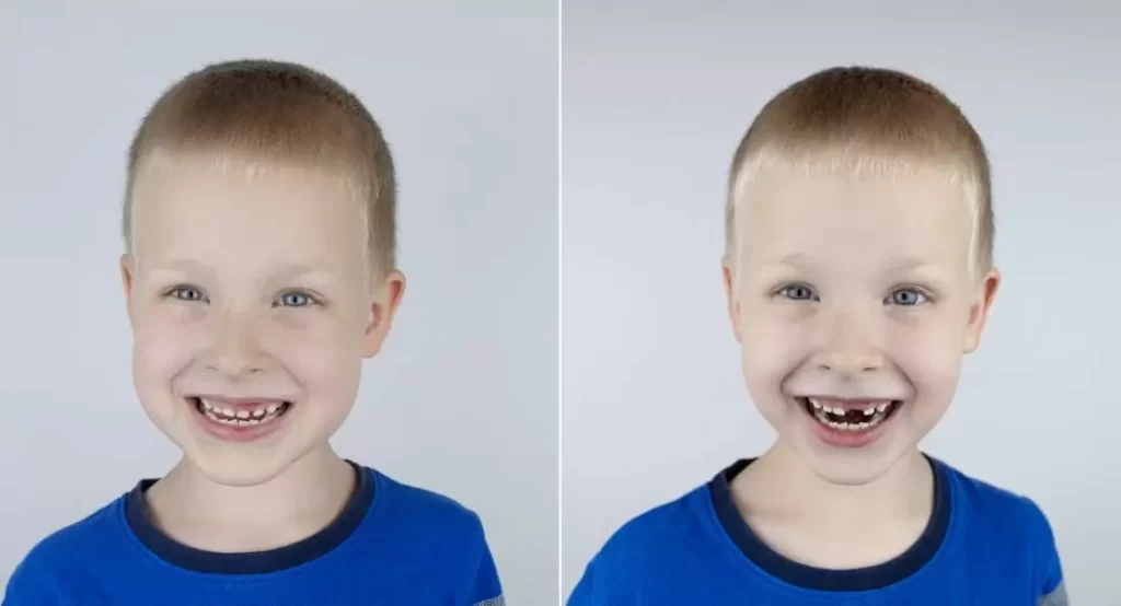 Before-and-after.-Falling-out-milk-tooth.-Blond-boy-in-photo-has-a-loose-milk-tooth.jpg