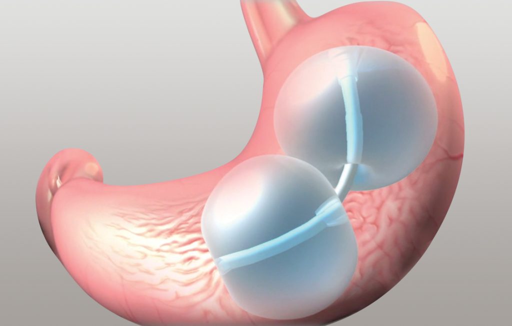 Gastric Balloon Melbourne – Complete Weight Loss Solution