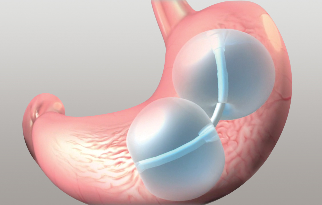 Gastric Balloon Melbourne – Complete Weight Loss Solution